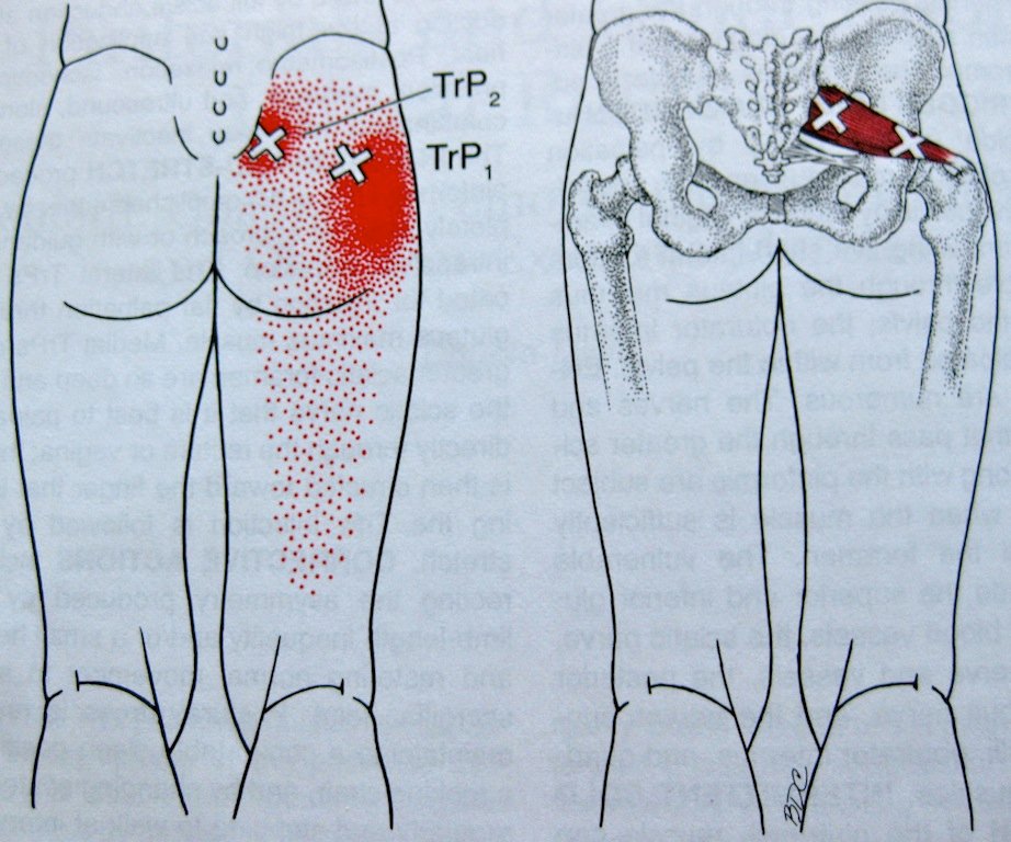 Hip Pain | The Easy Fix